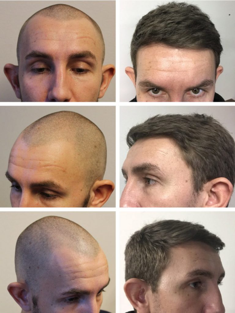 Hair transplant results in a year