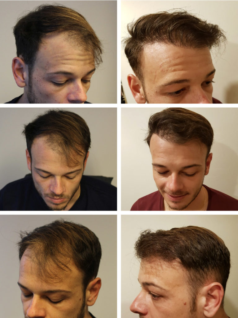 Hair transplant before and after images