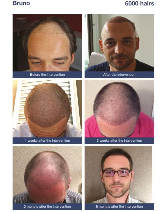 Mature / receding hairline transplant