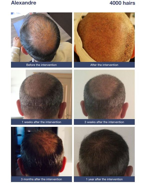 Thinning hair at the vertex: hair transplant 